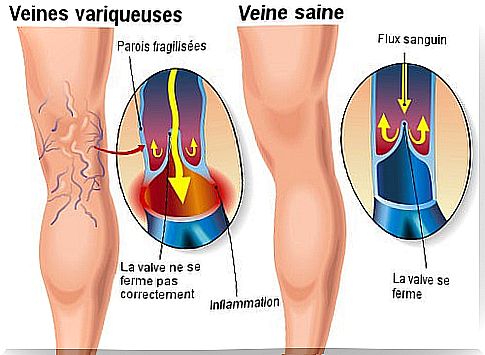 How to treat varicose veins?