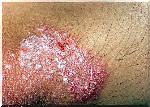 Skin disease 