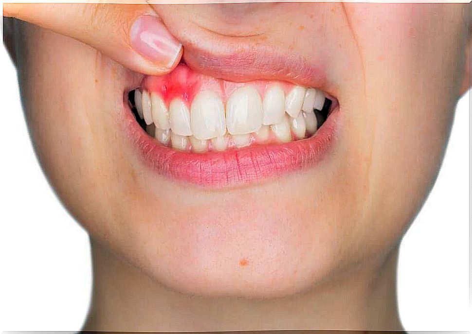 Bleeding gums may be due to inflammation
