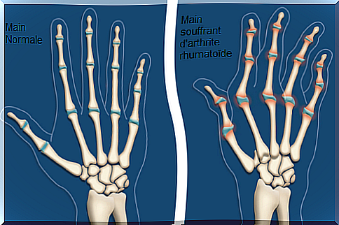 rheumatoid arthritis (1)