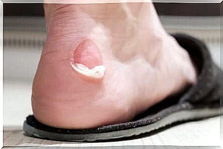 A blister on the foot.